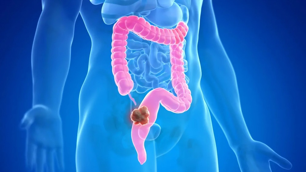 Understanding Colorectal Cancer: Symptoms, Risk Factors, and Prevention